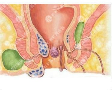 南寧哪個(gè)醫(yī)院可以做肛周膿腫？